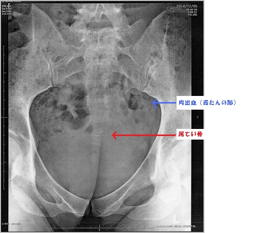 尾てい骨骨折の種類(レントゲン写真画像付き) - 尾てい骨骨折治療ガイド