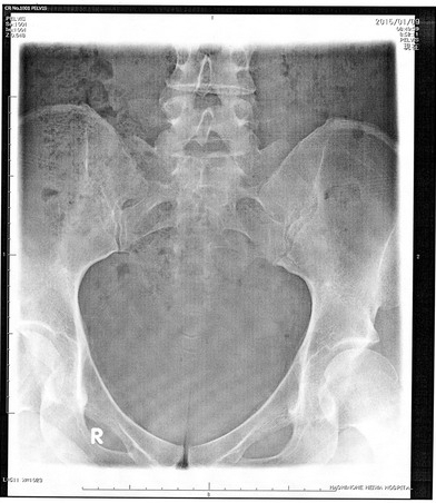 尾てい骨骨折１ヵ月後のレントゲン写真画像 - 尾てい骨骨折治療ガイド