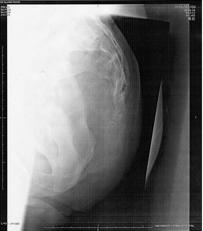 尾てい骨骨折１ヵ月後のレントゲン写真画像 - 尾てい骨骨折治療ガイド