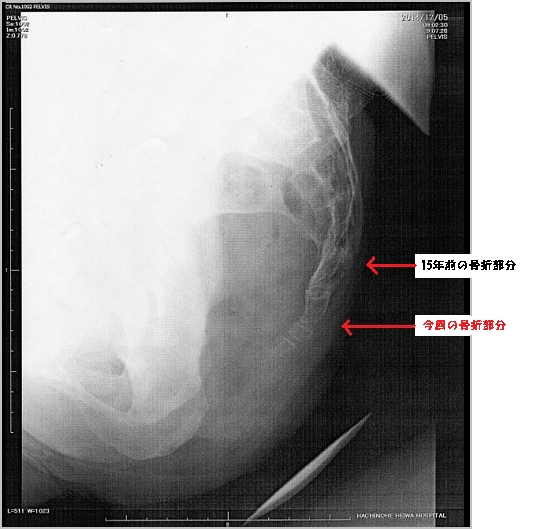 尾てい骨骨折の種類 レントゲン写真画像付き 尾てい骨骨折治療ガイド